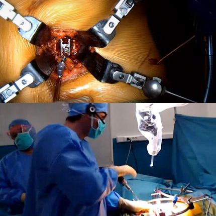 Chirurgie du rachis lombaire par voie antérieure