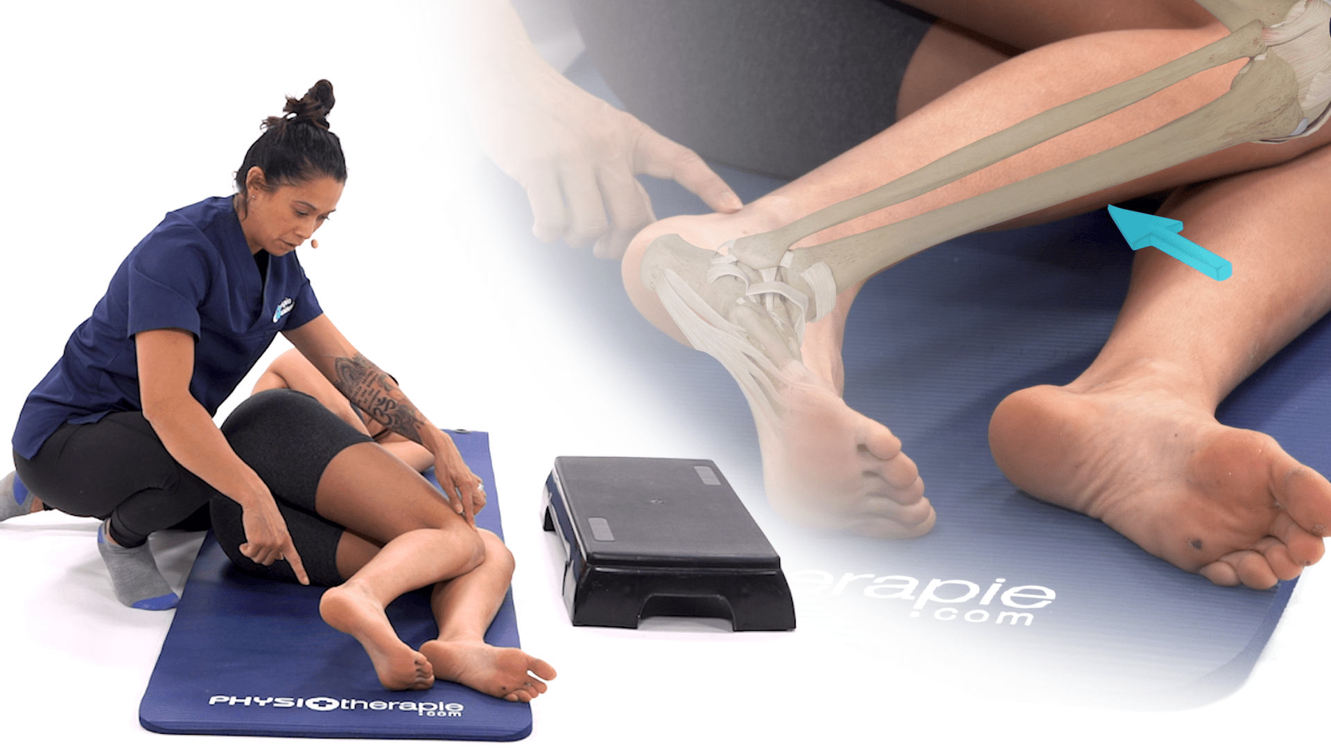 Tendinopathie Fémoro patéllaire