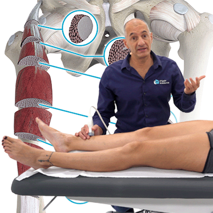 Lésion musculaire : échographie du quadriceps